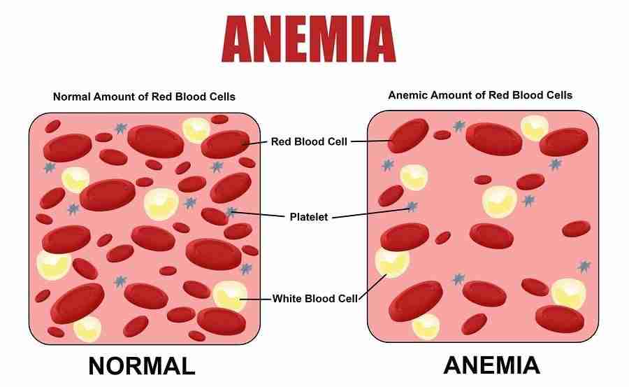 Gary Collier Blog Anemia