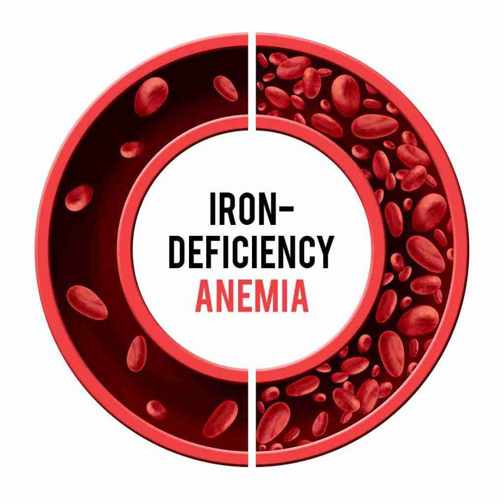 Gary Collier Blog Anemia