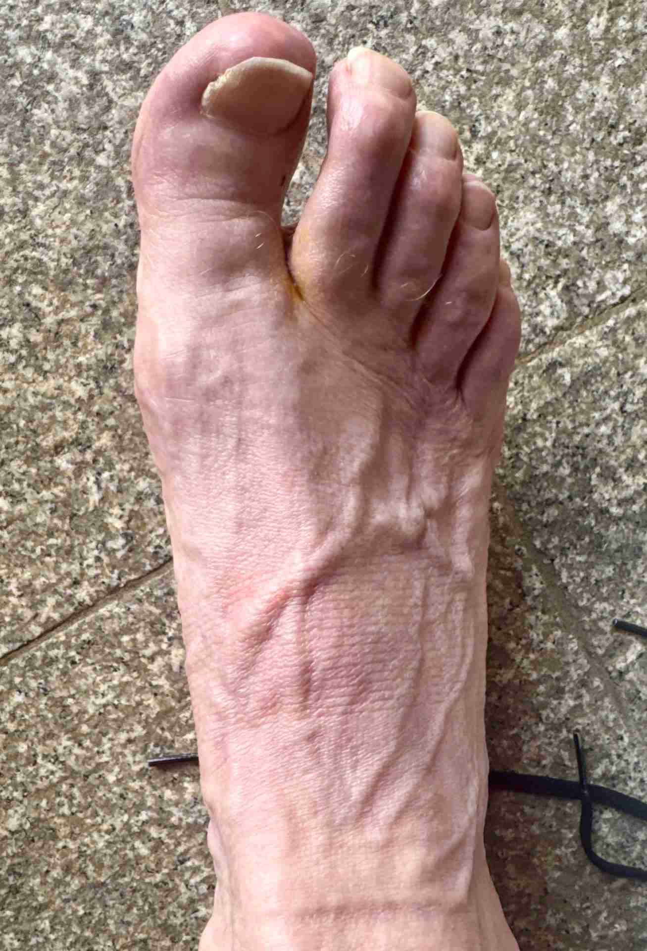 Foot pain management with photobiomodulation